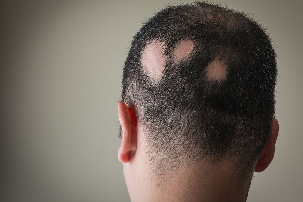 Understanding the Science Behind Hair Loss